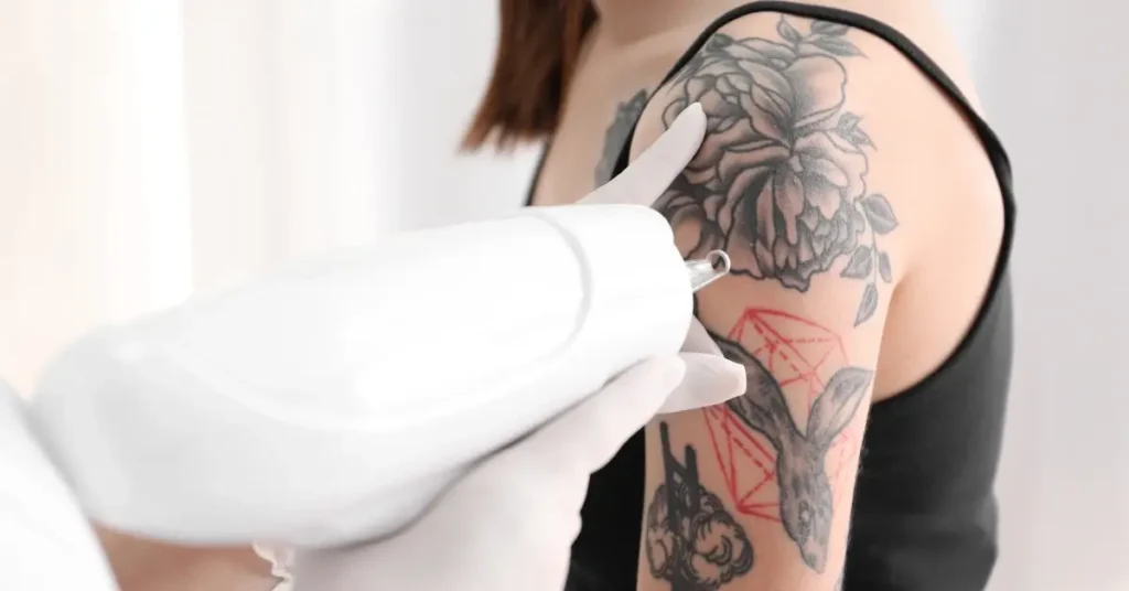 How Many Sessions to Remove Tattoo