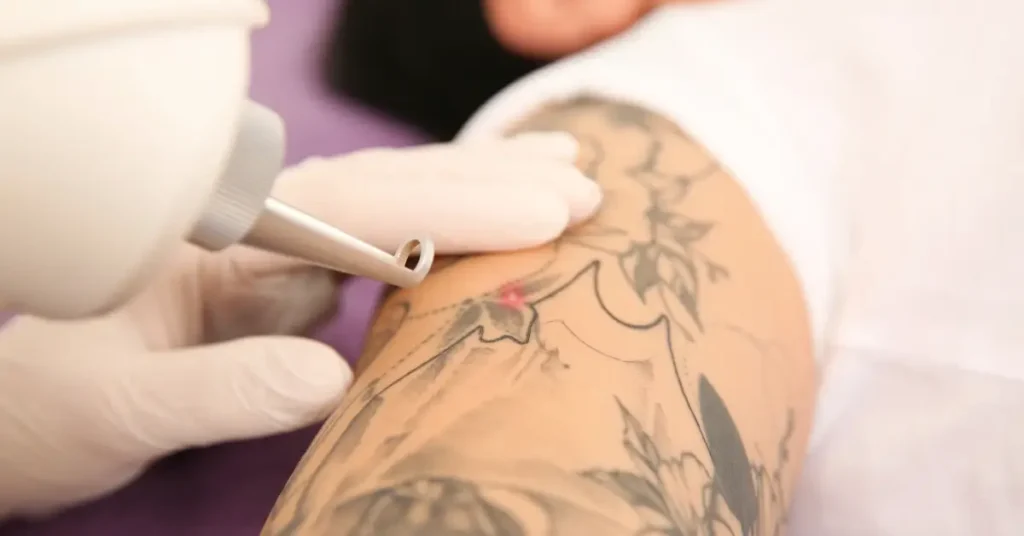 How Many Session Tattoo Remove