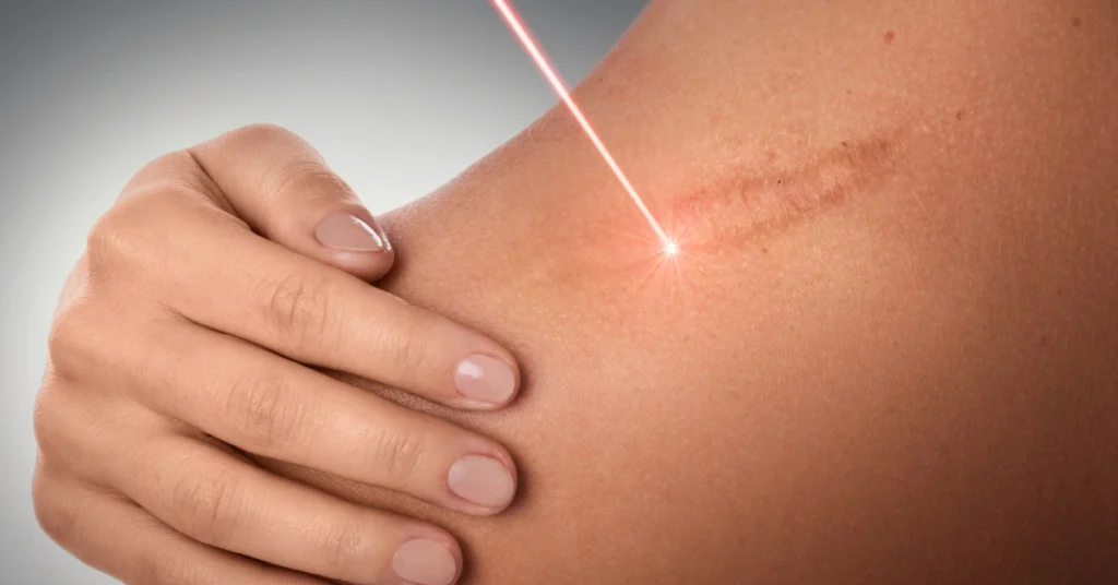 tattoo removal scar